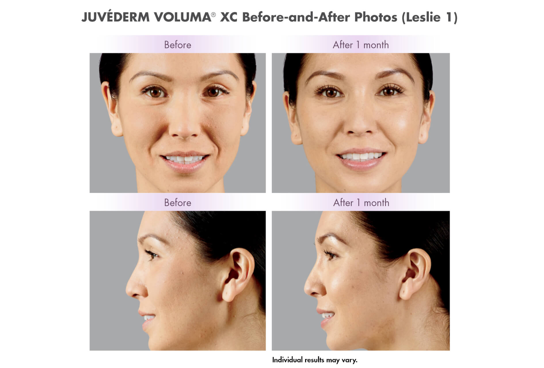new-u med spa services voluma-before-and-after 2