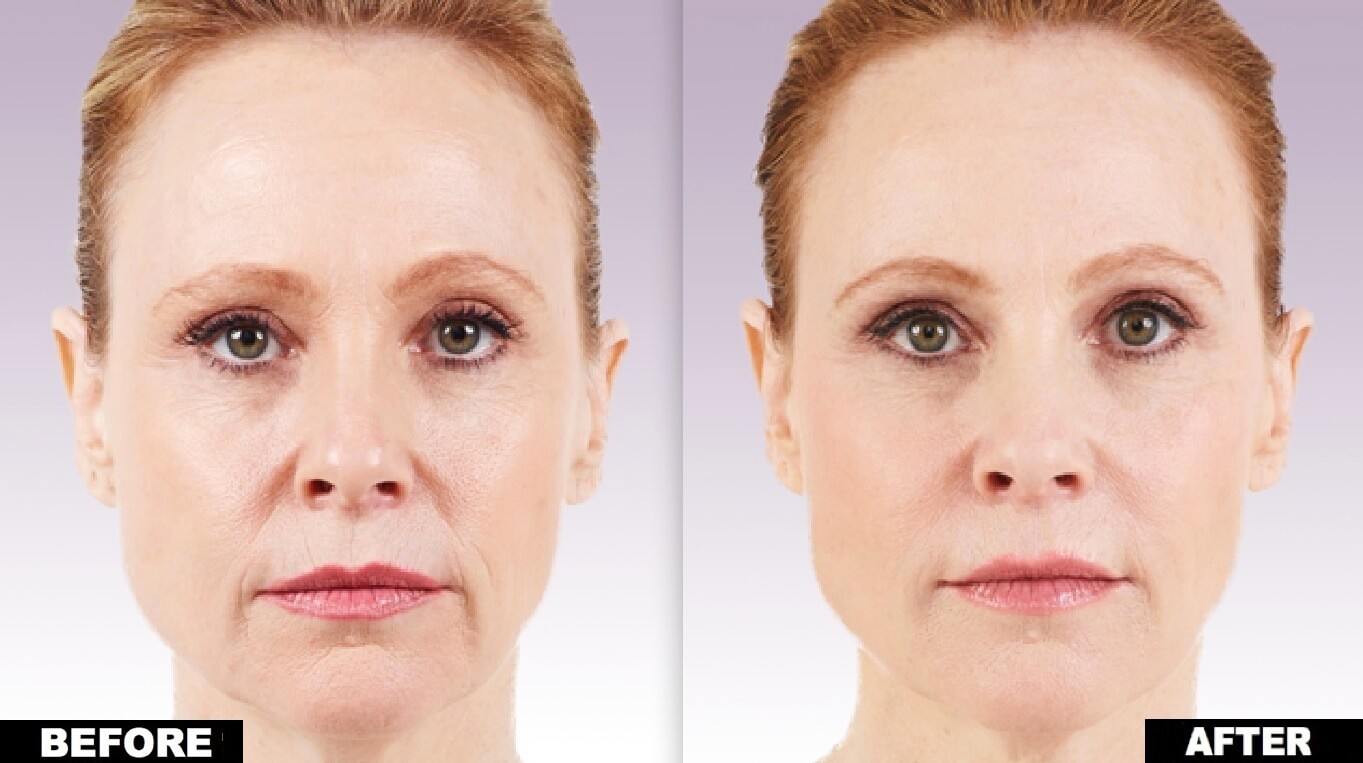 new-u med spa services voluma-before-and-after